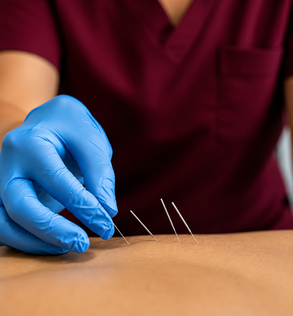 Acupuncture and dry needling therapy session for pain relief at PhysioCan